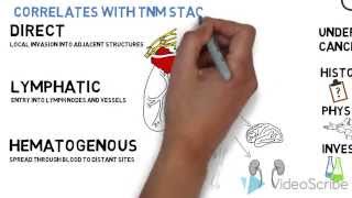 Kidney Cancer Treatment for Stage 4 Metastatic [upl. by Kata]