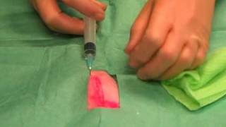 Suturing 1 Infiltrating local anaesthetic [upl. by Analiese395]