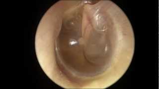 Serous Otitis Media [upl. by Maryn]