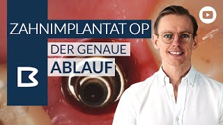 Zahnimplantat OP  Der genaue Ablauf [upl. by Acinaj543]