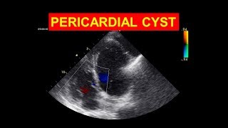 Pericardial Cyst  A rare echo finding [upl. by Ayerhs]