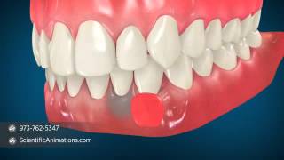 Gum Grafting Surgery  Dental Animation [upl. by Frerichs370]