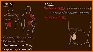 Acute Cholecystitis 23 [upl. by Anayia]