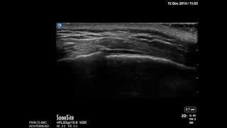 Ultrasound guided caudal epidural injection by Dr Murli Krishna [upl. by Anelat]