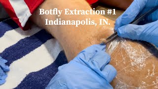 Botfly Extraction  55 day gestation  explosive extraction [upl. by Hayouqes]