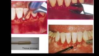 Gingivectomy amp Gingivoplasty [upl. by Parent616]