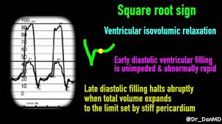 Constrictive pericarditis [upl. by Lesig]