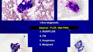 Thyroid Cytology I Approach [upl. by Oiliruam]