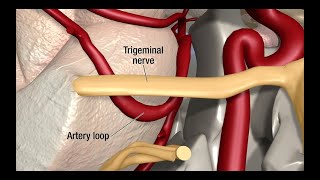 Trigeminal Neuralgia Treatment Explained by Neurologist [upl. by Llenyr]