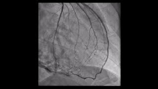 Constrictive Pericarditis [upl. by Idnahr]