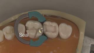 Class II Composite Restoration  Stevenson Dental Solutions [upl. by Devonne]