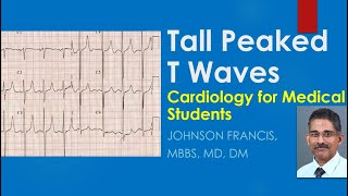 Tall Peaked T Waves  Cardiology for Medical Students [upl. by Ayocat]