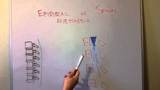 Epidural vs Spinal Anesthesia [upl. by Cooley677]