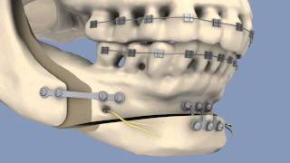 BSSO amp Osseous Genioplasty [upl. by Ecar]