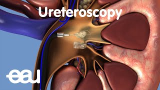 Removal of kidney stones URS [upl. by Lacefield]