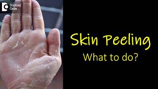 What causes skin peeling from fingers and feet How to manage  Dr Rasya Dixit [upl. by Corvese]