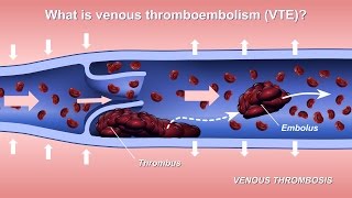 Reversing Valve Incompetence in Veins [upl. by Ainit]