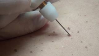 Hyperkeratosis removal with Plexr [upl. by Esiled726]