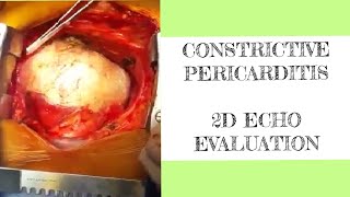 Constrictive pericarditis  2D ECHO evaluation [upl. by Mastat]