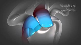 Shoulder Arthroscopy  Rotator Cuff Repair [upl. by Rem487]