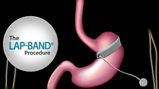 Fast Facts about The LAPBAND® procedure [upl. by Idham]