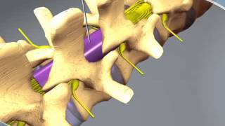 What to expect during an Epidural Steroid Injection at RAYUS [upl. by Nauaj]