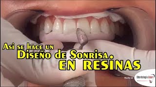 Asi se hace un Diseño de Sonrisa en resinas  Odontología Láser DiseñoDeSonrisa [upl. by Inaej]