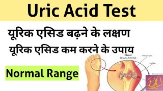 Uric Acid Test in Hindi  uric acid treatment  uric acid symptoms [upl. by Earissed]