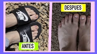 CÓMO BLANQUEAR UÑAS AMARILLAS DE LOS PIES [upl. by Rennob]