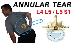 Annular Tear L4L5 L5S1 Disc Bulges [upl. by Lyrem]