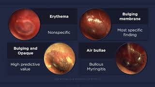 Acute Otitis Media Otoscopic Findings [upl. by Gnaw791]