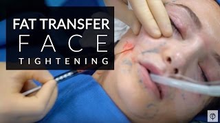 IMPROVE FACE VOLUME WITH CONTOURED CHEEKS EYEBROWS AND FOLDS USING FAT TRANSFER  JASON EMER MD [upl. by Kern770]