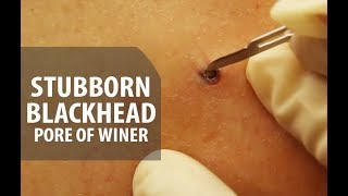 Stubborn Blackhead Removal  Dr Derm [upl. by Recneps]