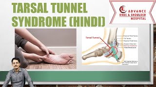 Tarsal Tunnel syndrome Hindi [upl. by Pontone]