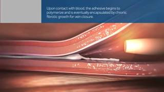 VenaSeal Closure System animation [upl. by Meeker]