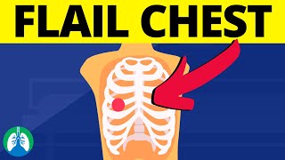 Flail Chest Medical Definition  Chest Trauma [upl. by Starbuck]