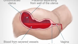 Postpartum Hemorrhage [upl. by Latsyrcal]