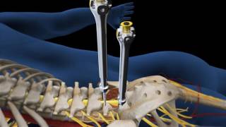 Lumbar Fusion of L5 S1 Animation [upl. by Atinauj]