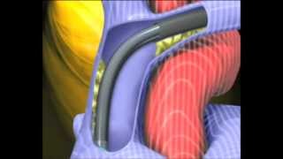 Cardiothoracic surgery Laser assisted lead extraction [upl. by Olly]