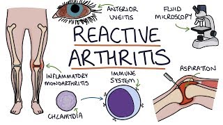 Understanding Reactive Arthritis [upl. by Maryann]