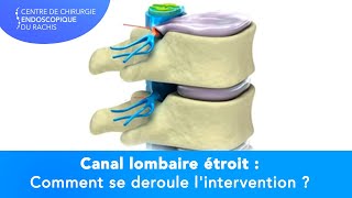 CANAL LOMBAIRE ÉTROIT  Comment se déroule lintervention [upl. by Lambertson]