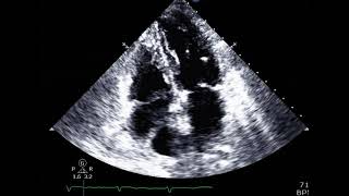 Flail posterior mitral valve leaflet [upl. by Diamante975]