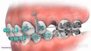 Orthodontic MiniImplant TAD or TSA [upl. by Eilrak]