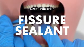 Placement of a Fissure Sealant [upl. by Onida340]