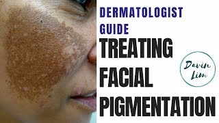 How to treat PIGMENTATION [upl. by Lennej]