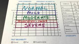 How to Read Your Audiogram [upl. by Sisxela]