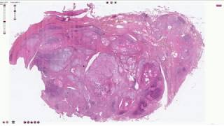 Hashimoto Thyroiditis  Histopathology [upl. by Inerney]