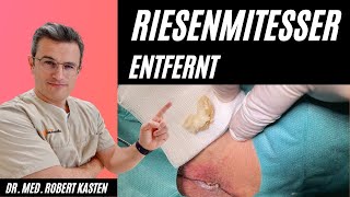 RIESENKOMEDO in der Leiste entfernt Hautarzt kann es kaum fassen Mitesser pimple giant comedone [upl. by Anehs258]