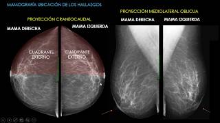 Mamografía Parte 1 [upl. by Murrell]