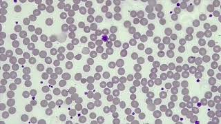 WBC Differential WBCPLT Estimate RBC Morphology [upl. by Elburt]